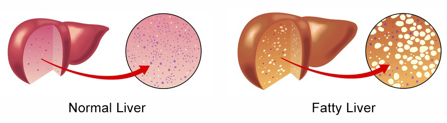 Fatty Liver, Hepatic Steatosis